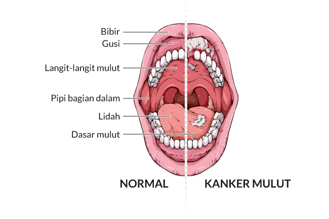 Dasar tentang Penyakit Gejala, Penyebab, dan Pencegahannya